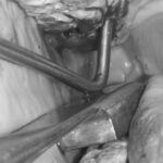 Stütz- und Führungsset für dentale Hebel – Bild 5